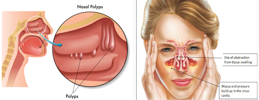 Stuffy Nose Causes Symptoms And Diagnosis