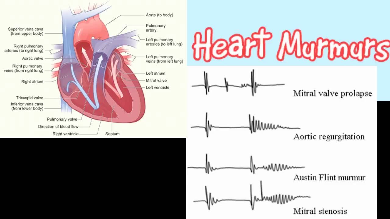 Heart Murmurs Causes Treatments Types And More