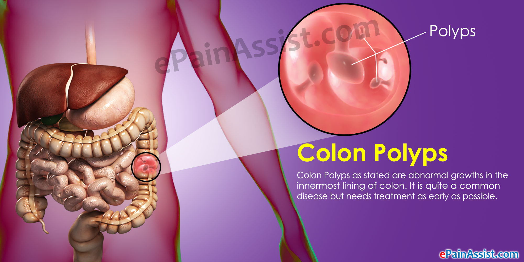 Colon Polyps Symptoms Types Causes Prevent Pictures