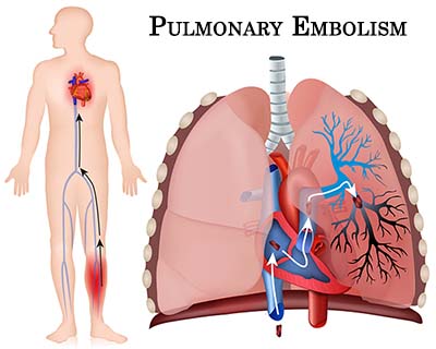 Pulmonary Embolism Take Measures To Lower Your Risk