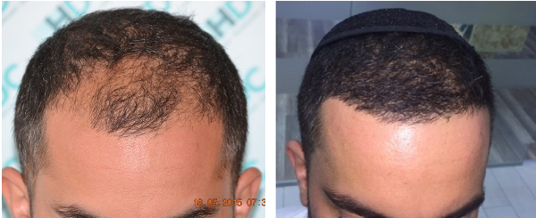 Hair Transplant – Permanent Hair Restoration