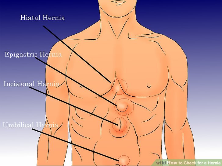 Hiatal Hernias Causes and Treatment