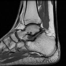 MRI-ANKLE JOINT (BOTH) LabTest