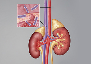 Kidney Infection