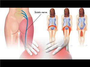 How to Get Rid of Sciatica Pain