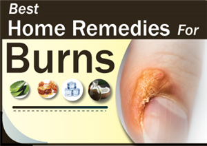 Best Home Remedies For Burns