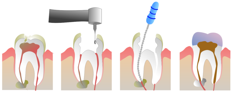 What-is-a-Root-Canal-Overview-Treatment