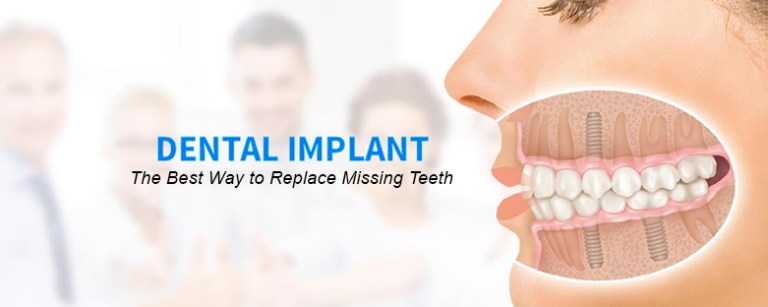 Dental Implants