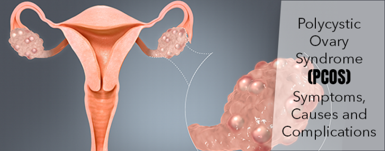 Polycystic Ovary Syndrome (PCOS) - Symptoms, Causes and Complications