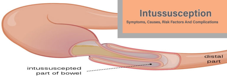 Intussusception--Symptoms,-Causes,-Risk-Factors-And-Complications