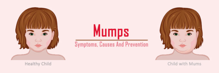 Mumps