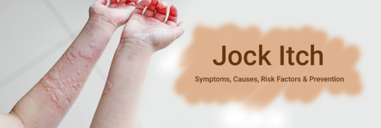 Jock-Itch--Symptoms,-Causes,-Risk-Factors-And-Prevention