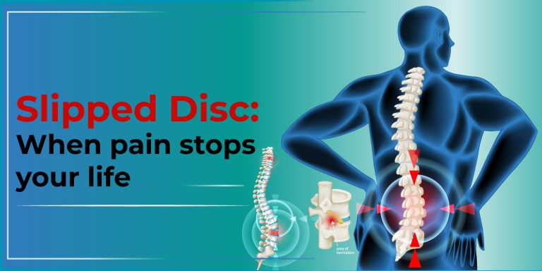 herniated disk, slipped disc