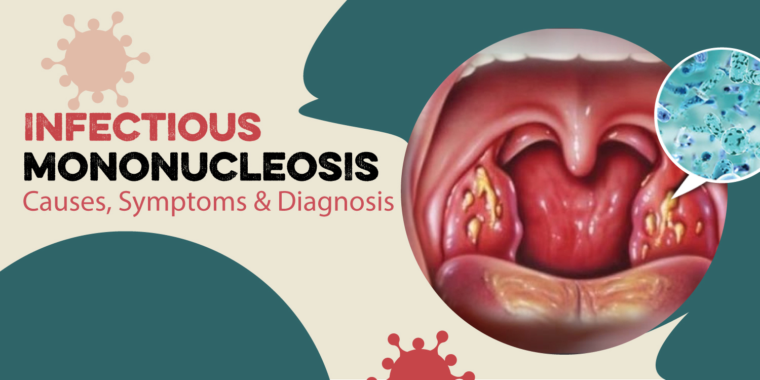 Infectious Mononucleosis Causes Symptoms & Diagnosis