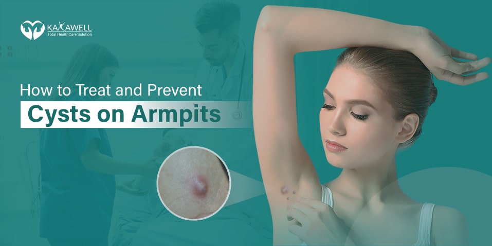 How to Treat and Prevent Cysts on Armpits